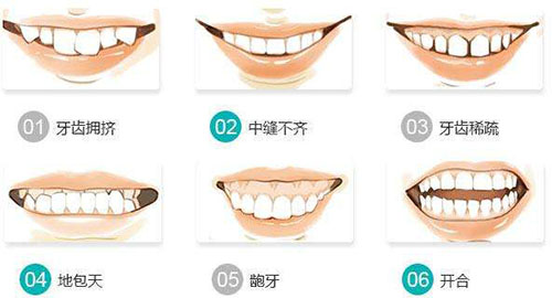需要牙齿矫正的牙齿类型