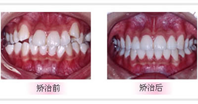 广州牙齿矫正前后对比案例.jpg