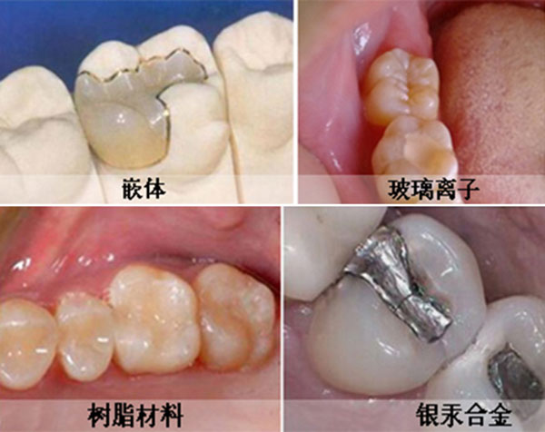 补牙的几种材料