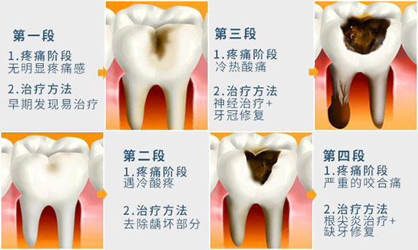 补牙的四个阶段