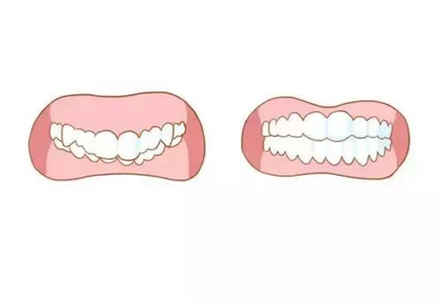 牙齿矫正适合的情况二.jpg