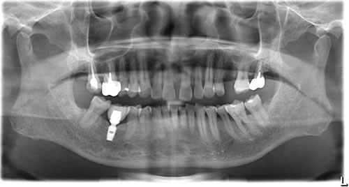 牙齿矫正的CT.jpg