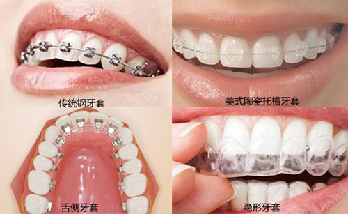 牙齿矫正的方法