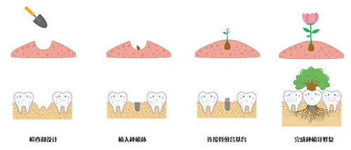 种植牙过程动画图解