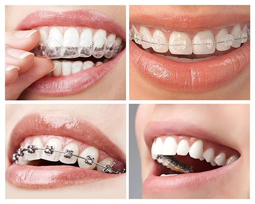 牙齿矫正的四种方法