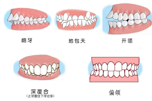 需要进行牙齿矫正的五种情况