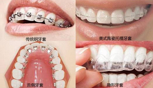 四种不同的牙齿矫正方法