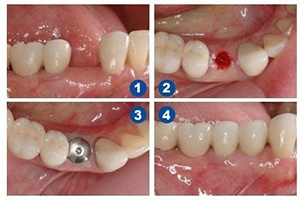 长沙辰睦口腔医院牙齿种植案例