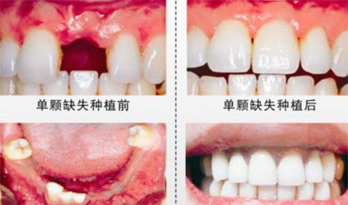 宁波恒美口腔种植牙案例