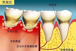 牙周病会给生活带来怎样的影响？