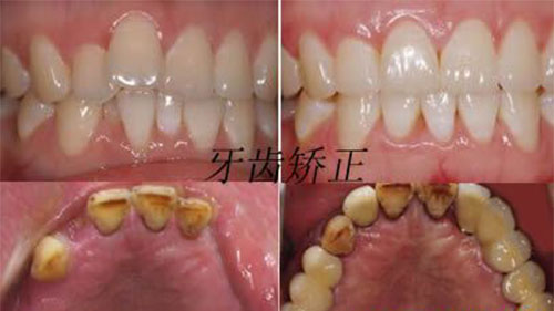 安徽合肥维多利亚口腔中心牙齿矫正案例