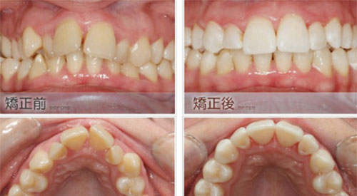 北京圣贝口腔医院牙齿矫正案例