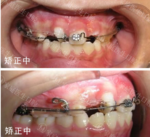 广州中家医家庭医生做牙齿矫正好吗