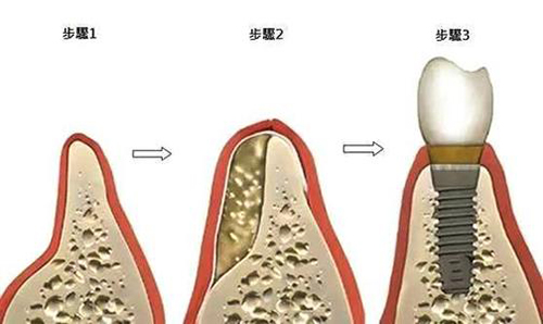 种植牙植骨过程