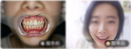 佛山美莱口腔医院牙齿矫正案例