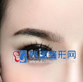 韩式微创双眼皮 美丽不留遗憾