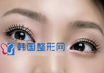 眼部综合整形 打造天使容颜