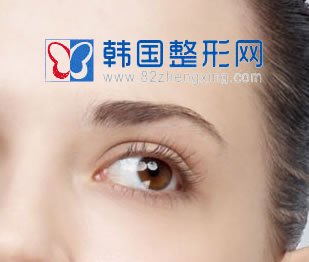 任何人都适合做双眼皮吗？