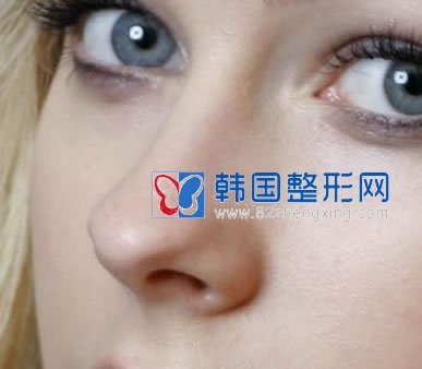 歪鼻如何矫正?