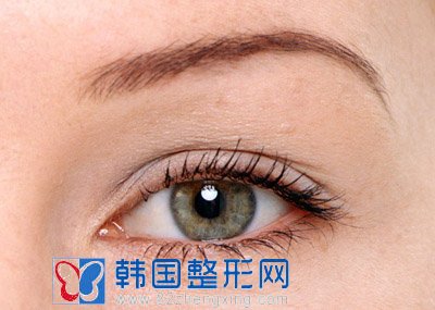 什么是埋线双眼皮手术？
