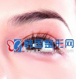 切开法双眼皮会留疤吗？