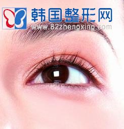 缝合法双眼皮手术效果如何