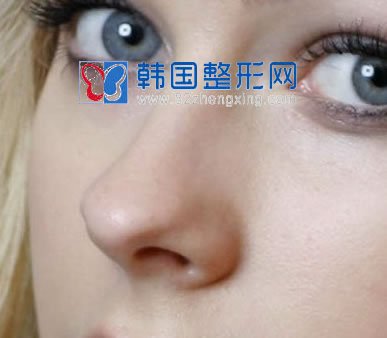 鼻尖整形术后恢复期应注意什么