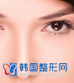 低鼻尖矫正术方法