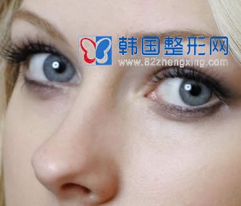切开法双眼皮怎么才算是成功呀？