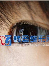 埋线双眼皮失败后如何选取修复方法