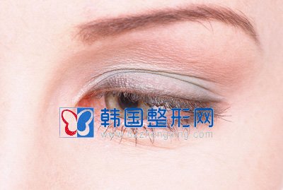 埋线双眼皮手术注意事项