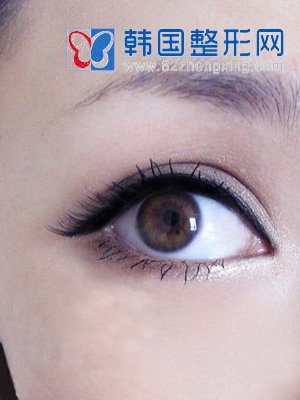 埋线法的适应人群有哪些？