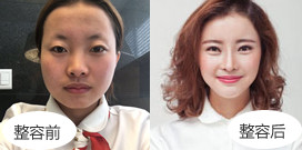 眼鼻综合整形后变女神