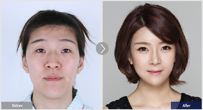 颧骨内推前后对比.png