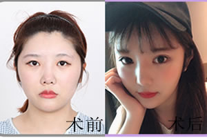 韩国菲斯莱茵颧骨内推手术案例.jpg