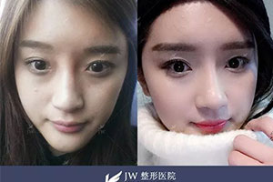 韩国JW整形医院隆鼻整形案例