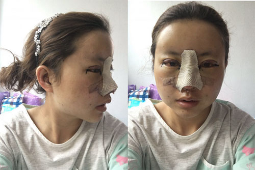 眼鼻综合整形过程