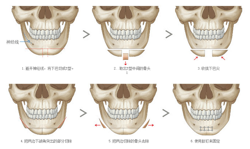 V-line手术方式