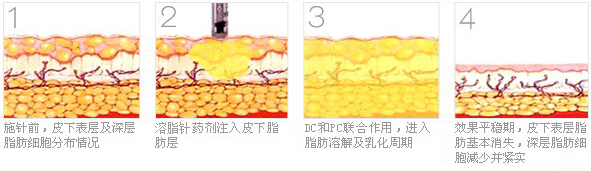 想减肥瘦身选择吸脂和溶脂哪个好
