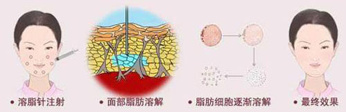 想减肥瘦身选择吸脂和溶脂哪个好