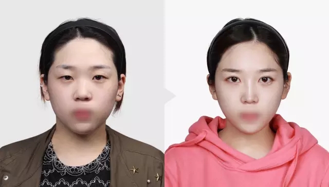 韩国TL整形医院的鼻翼缩小手术案例
