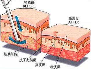 吸脂手术前后脂肪皮层变化