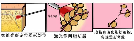 光纤溶脂过程