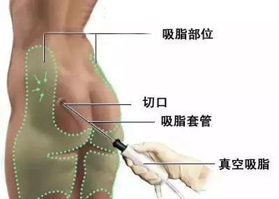 吸脂手术示意图