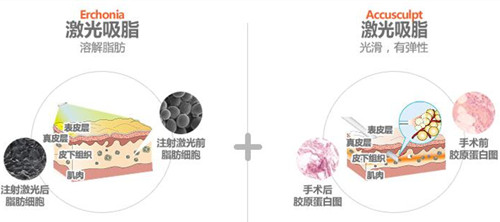 体引脂整形医院双重吸脂示意图