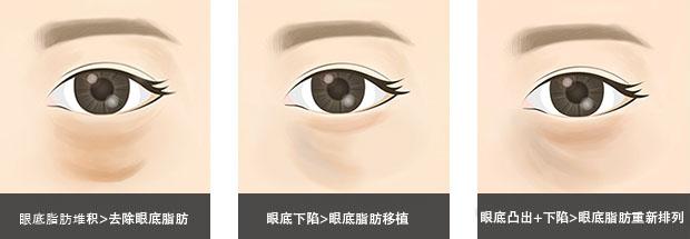 眼底脂肪重置去黑眼圈