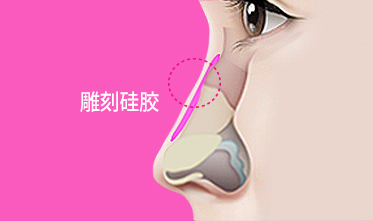 假体隆鼻特点