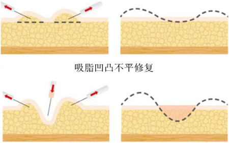 吸脂凹凸不平修复
