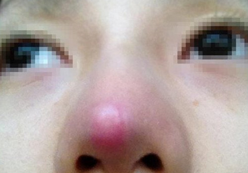 玻尿酸注射疼痛红肿