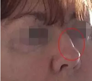 玻尿酸注射不吸收，周围游走